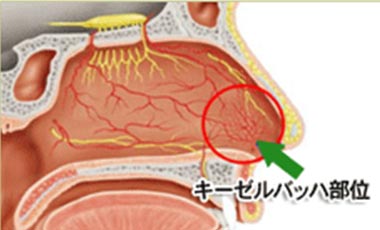 キーゼルバッハ部位（鼻中隔の前方）